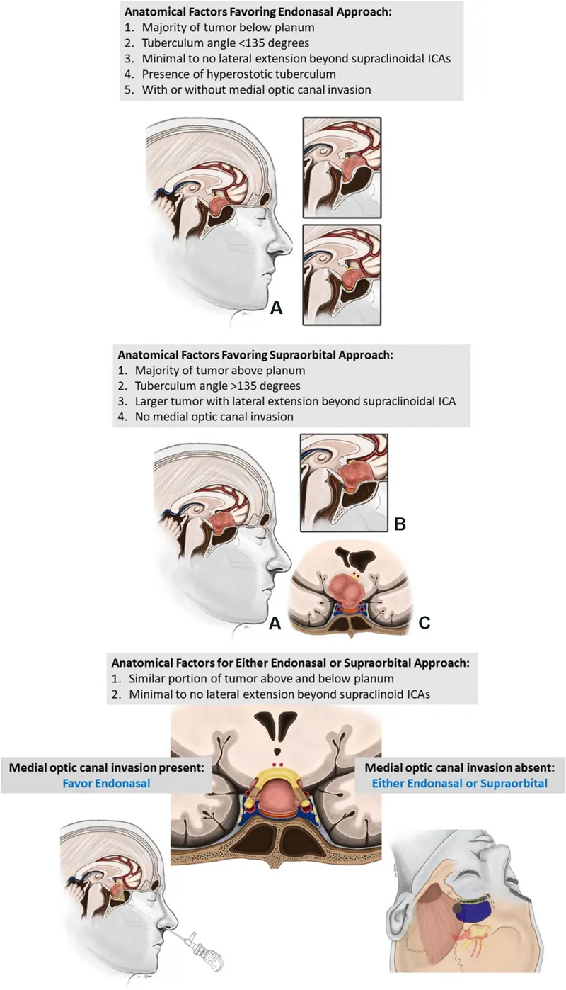 Surgical approaches for skull base tumors