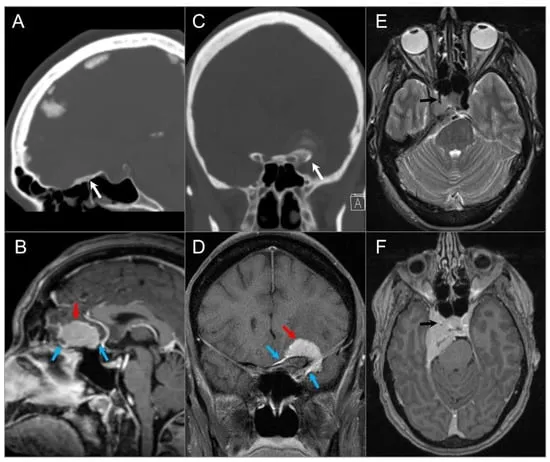 Skull base chordoma vs chondrosarcoma imaging