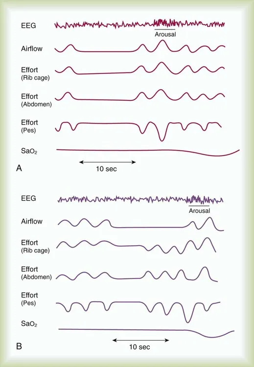 Polysomnography Tracings: Obstructive vs Central Apnea