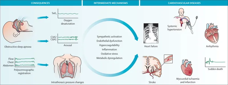 OSA Pathophysiology and Cardiovascular Complications