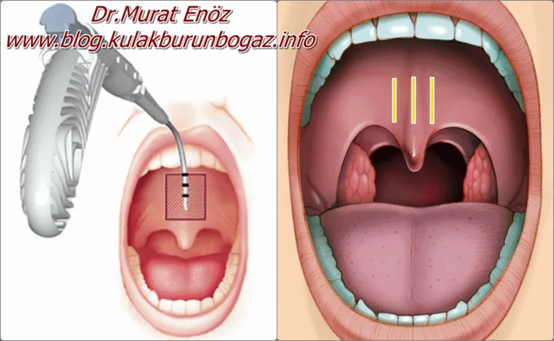 Palatal implants for OSA
