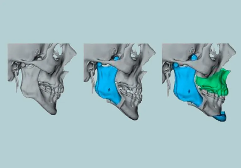 Maxillomandibular advancement for OSA