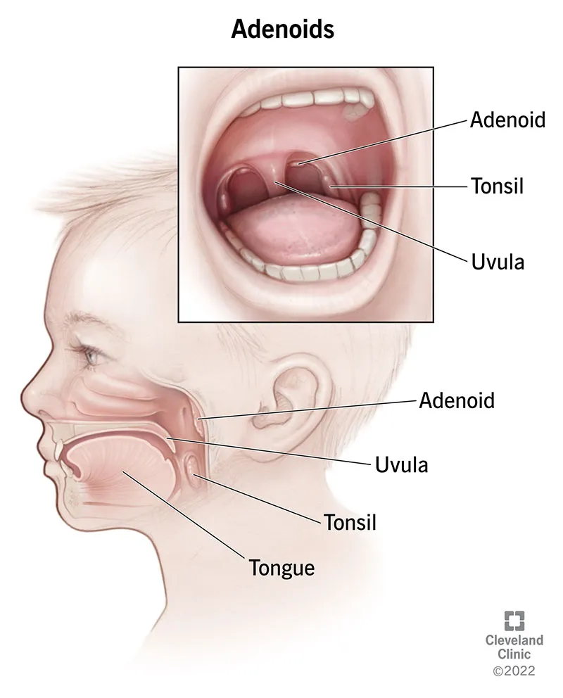Pediatric upper airway anatomy: adenoids and tonsils