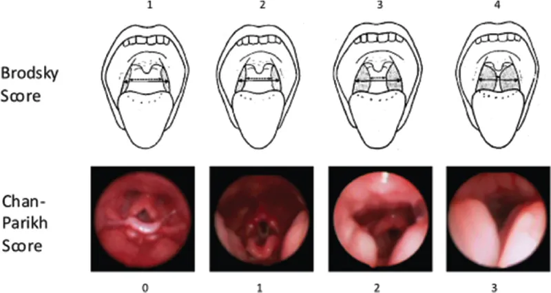 Brodsky and Chan-Parikh Scores for Tonsillar Hypertrophy