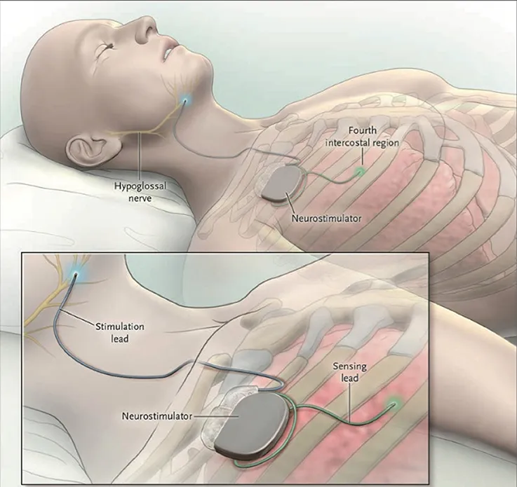 Upper Airway Stimulation System Placement