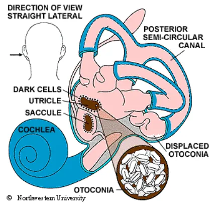 Displaced otoconia in posterior semicircular canal