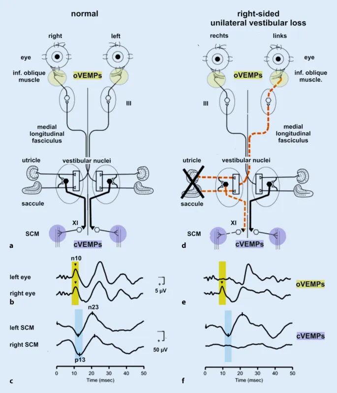 cVEMP and oVEMP pathways in normal and vestibular loss