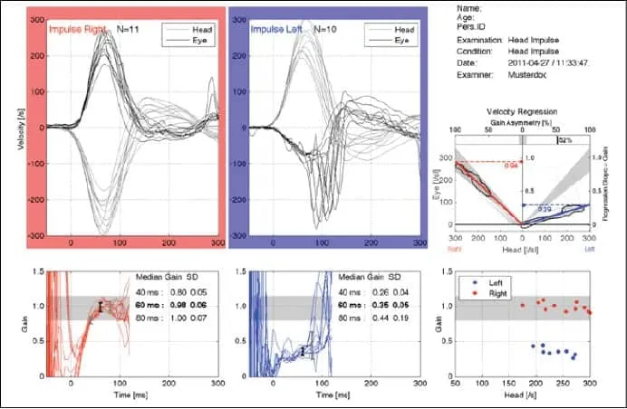 vHIT output: Normal vs. abnormal response with saccades