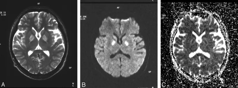 Bilateral globus pallidus necrosis in CO poisoning MRI