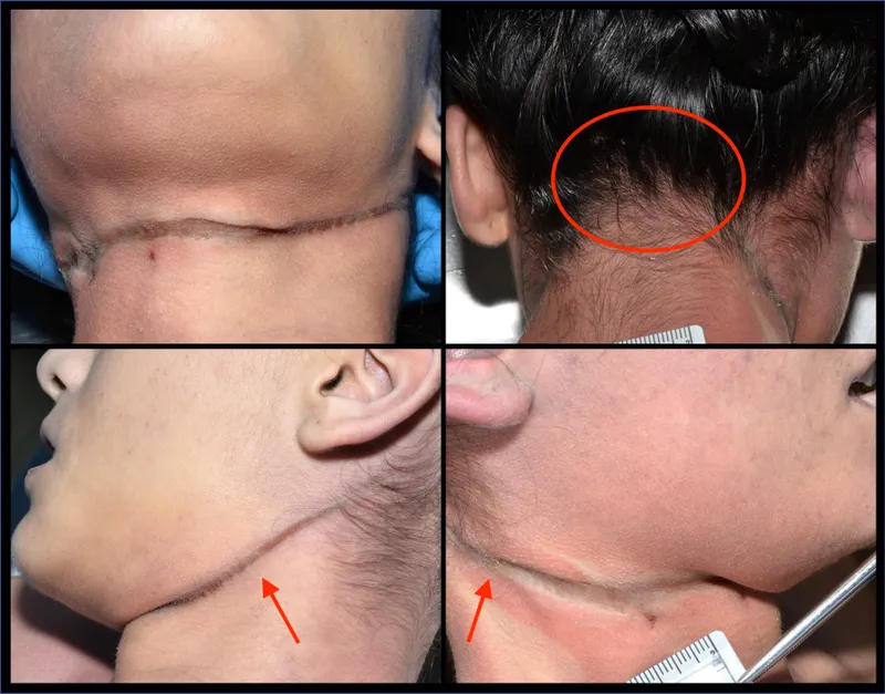 Ligature mark in hanging