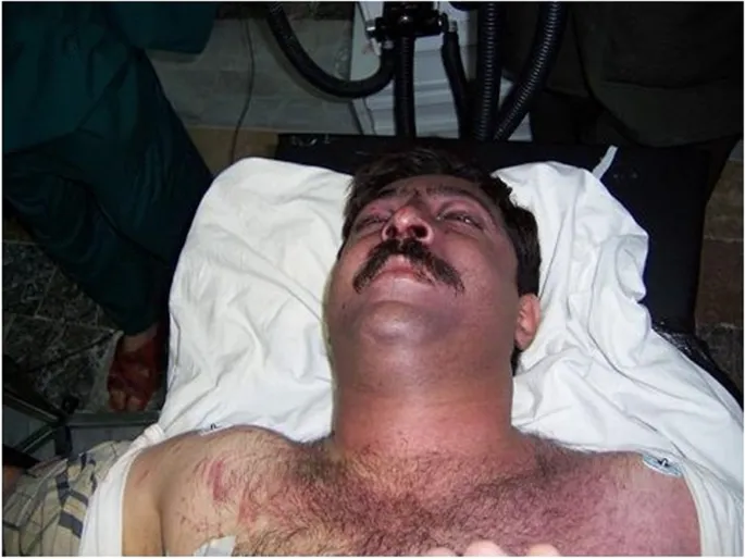 Masque ecchymotique in traumatic asphyxia