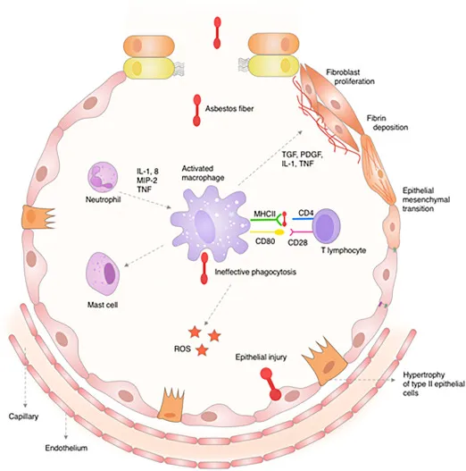 Pathogenesis of Asbestosis