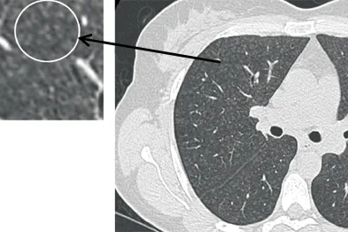 HRCT chest scan: Hypersensitivity pneumonitis features