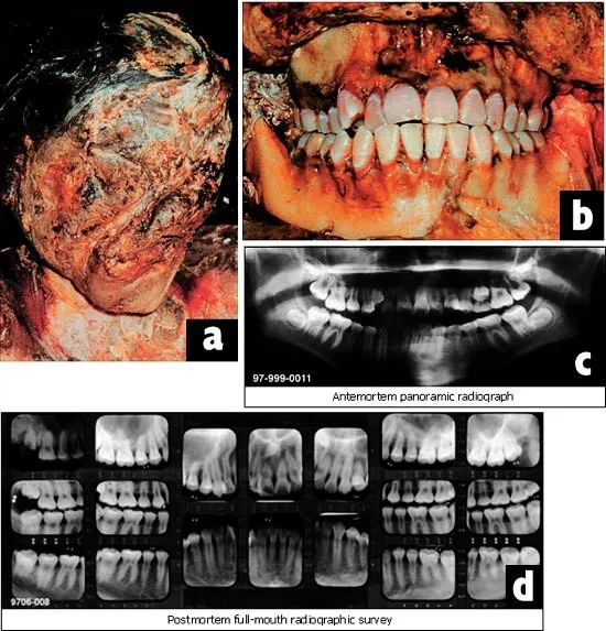 Dental ID: Antemortem vs Postmortem X-rays