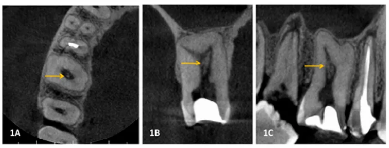 Dental Radiographs for Forensic Comparison