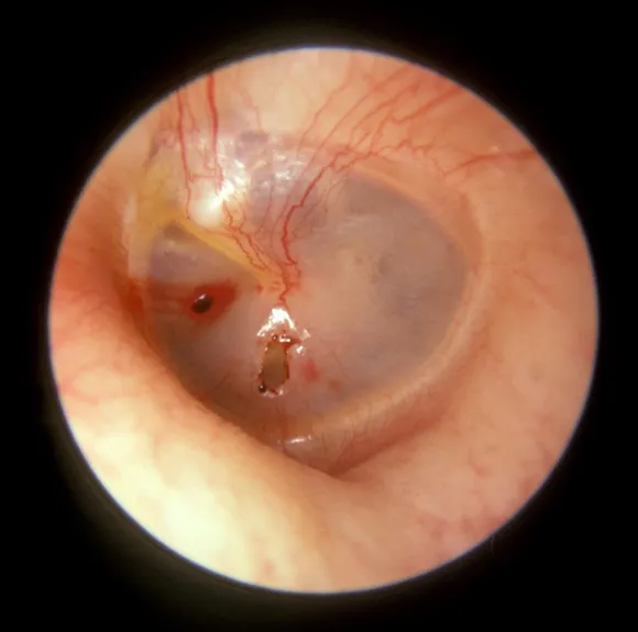 Tympanic membrane perforation from blast injury