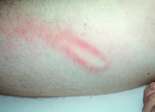 Tram-track bruise from cylindrical object impact