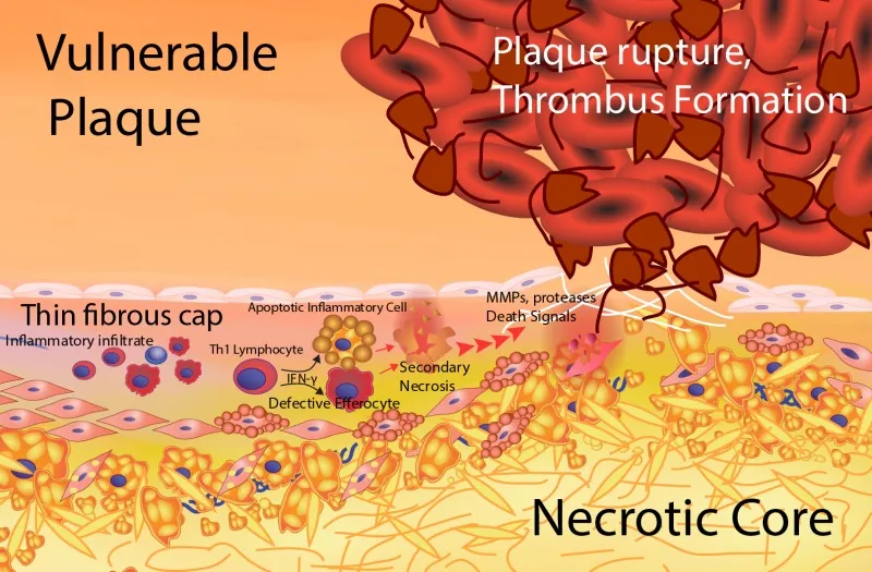 Vulnerable Plaque Rupture & Thrombus Formation