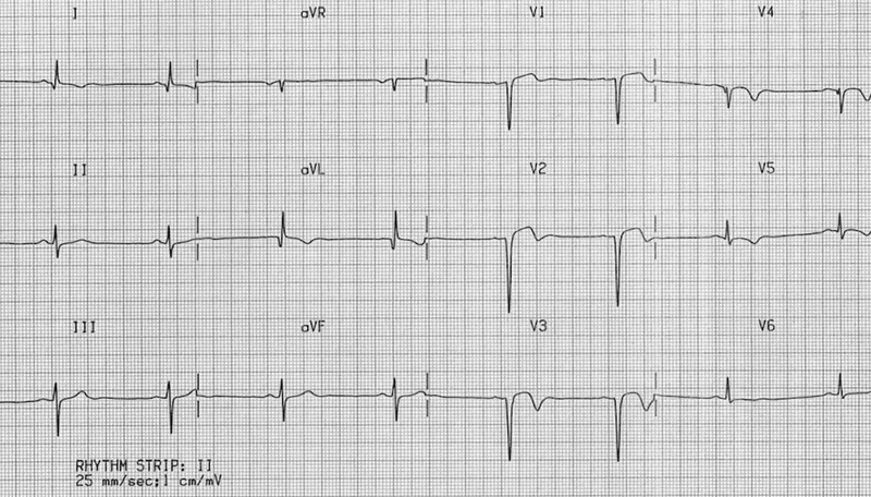 ECG: Left Ventricular Aneurysm with ST Elevation & Q Waves