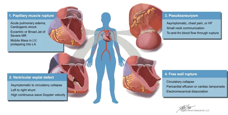 Post-MI Mechanical Complications: Ruptures & Defects