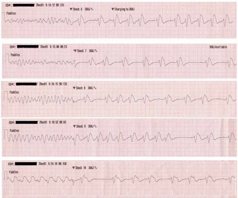 ECG: Ventricular Fibrillation to Sinus Rhythm Conversion