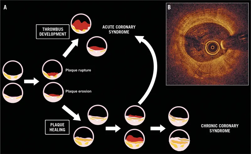 Plaque rupture, erosion, and thrombus development