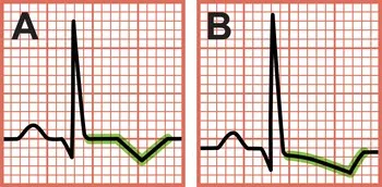 ECG: ST depression vs. T-wave inversion