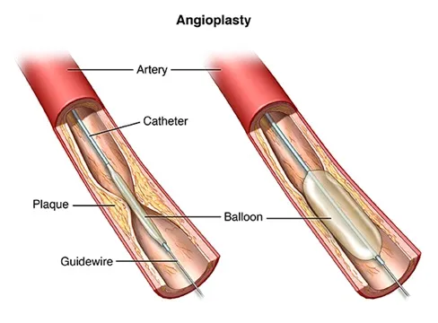 Angioplasty procedure with balloon catheter