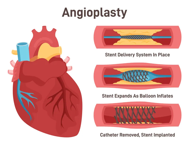 Coronary Artery Angioplasty with Stent Placement
