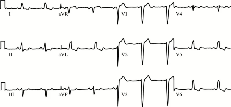 ECG showing LBBB with discordant ST elevation