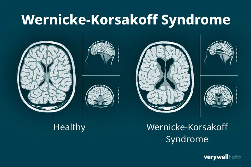 Wernicke-Korsakoff Syndrome Brain Changes