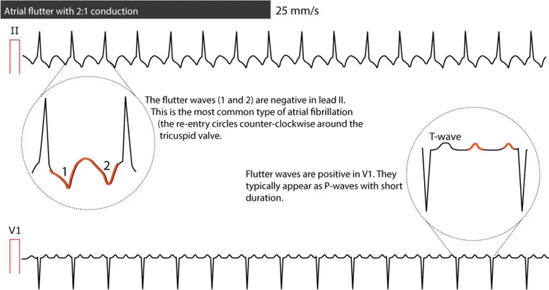 ECG: Atrial Flutter with 2:1 Conduction