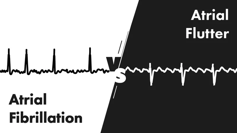 Atrial Fibrillation vs. Atrial Flutter ECG Comparison
