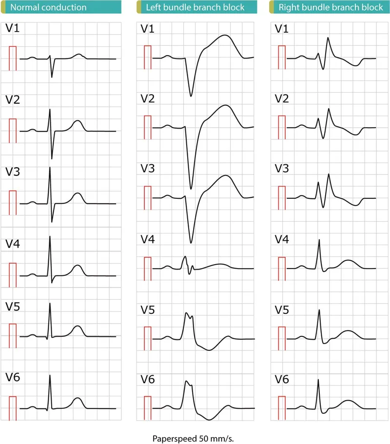 ECG: Normal, LBBB, and RBBB patterns compared