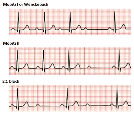 ECG: Mobitz I, Mobitz II, and 2:1 AV Blocks