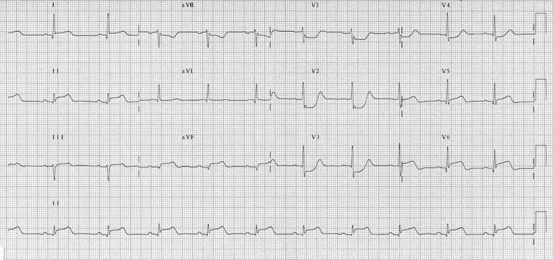 ECG showing transient ST elevation after cardioversion