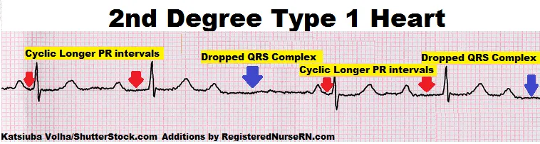 ECG: 2nd Degree Type 1 Heart Block (Wenckebach)