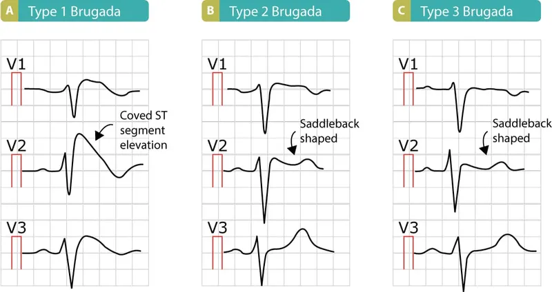 ECG patterns in Brugada syndrome types 1, 2, and 3