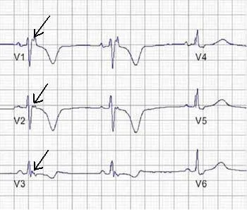 ECG showing Epsilon waves in ARVC