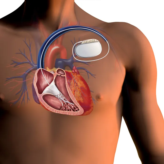 Pacemaker and ICD lead placement in heart chambers