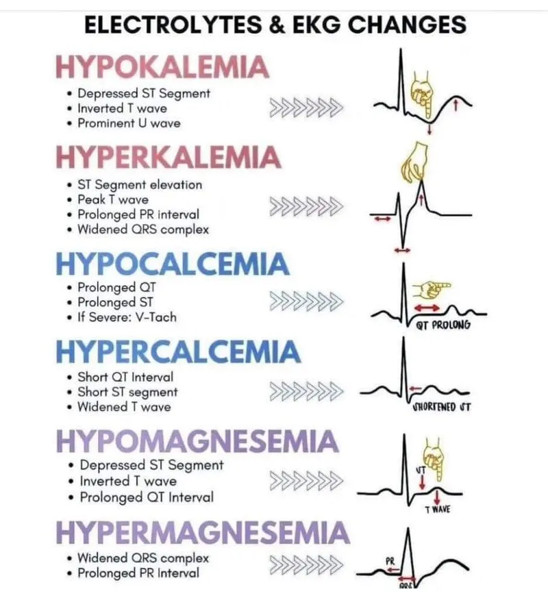 Electrolyte Imbalances and EKG Changes