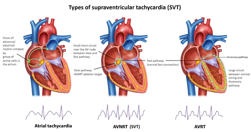 SVT: Atrial Tachycardia, AVNRT, and AVRT Pathways
