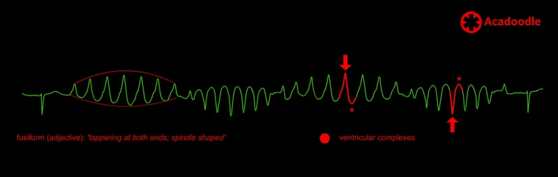 ECG: Torsades de Pointes with fusiform QRS