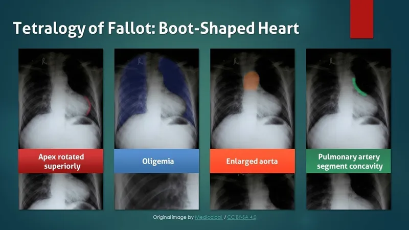 Tetralogy of Fallot: Boot-shaped heart on chest X-ray