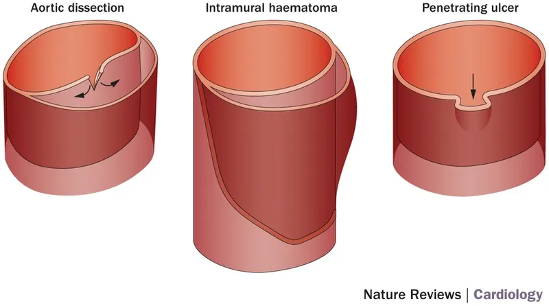 Acute Aortic Syndromes: Dissection, Hematoma, Ulcer