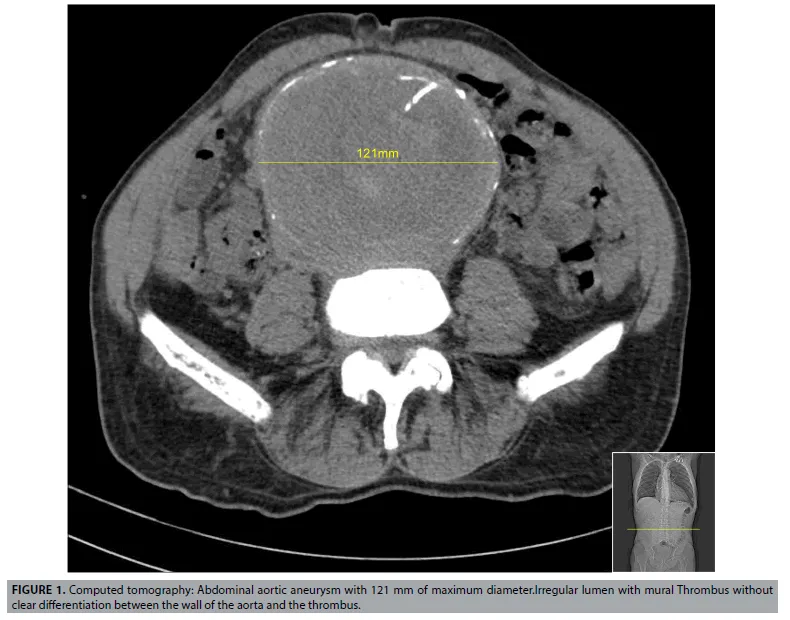 CT: Abdominal Aortic Aneurysm with Mural Thrombus