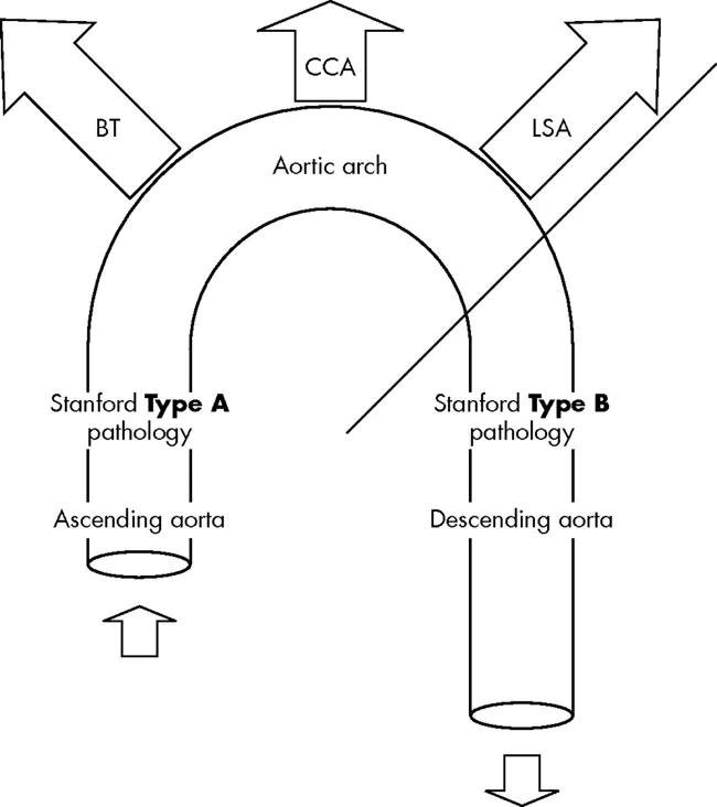 Stanford A and B Aortic Dissection Classification
