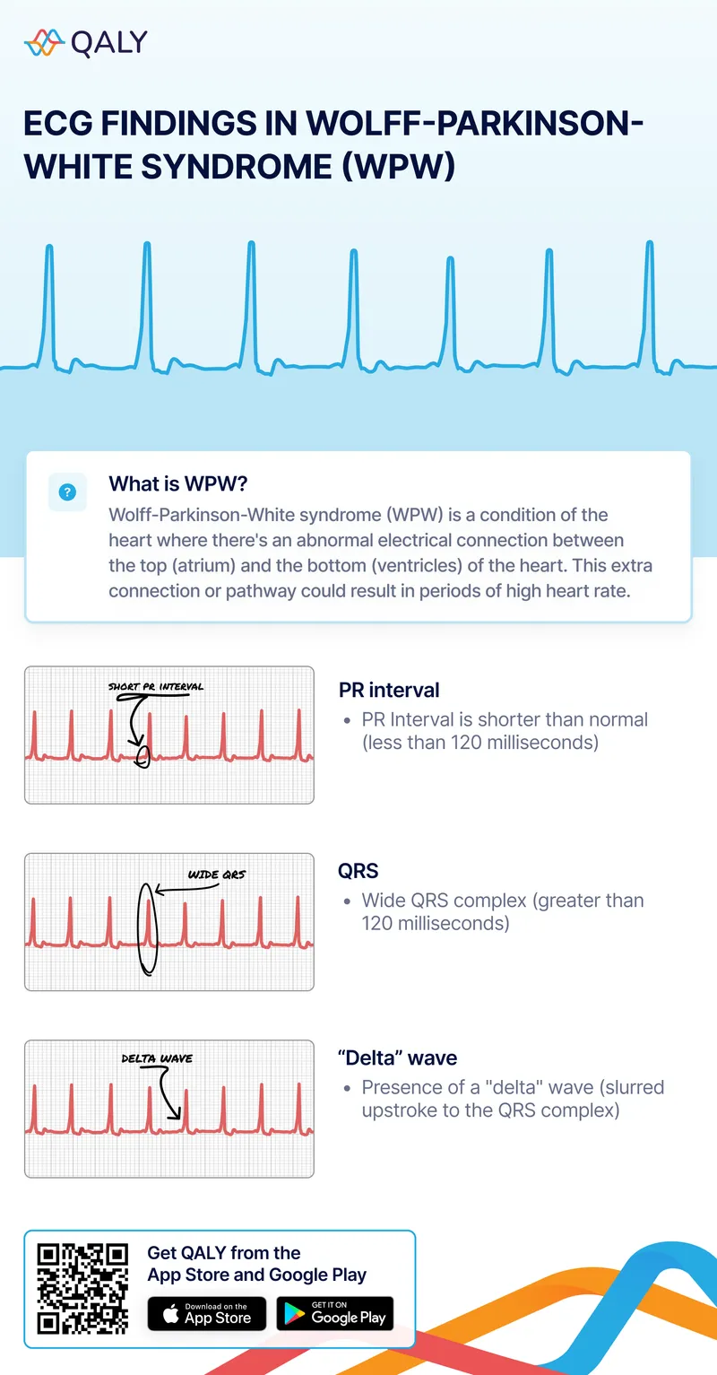ECG findings in Wolff-Parkinson-White syndrome (WPW)
