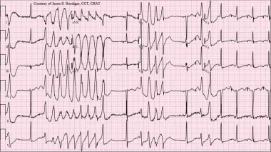 ECG: VT, VF, and Torsades de Pointes