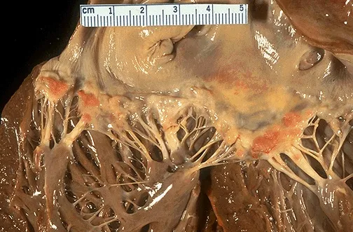 Libman-Sacks endocarditis: mitral valve vegetations